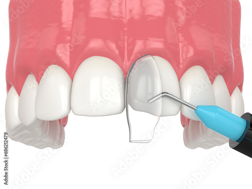 3d render of crooked tooth treatment using bonding procedure