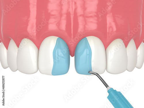 3d render of etching the enamel with a mild acid as a part of bonding procedure