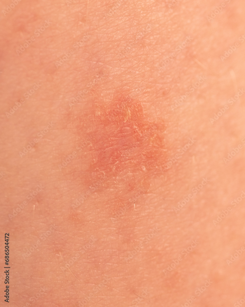 Close-up of a wound on the skin. Macro Close-up of a wound on the skin. Macro