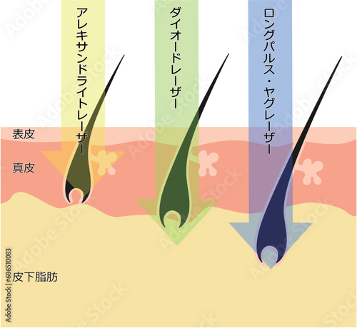 肌断面図で見る脱毛レーザーの違い