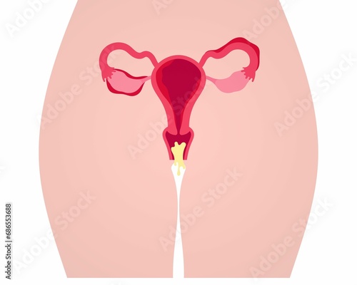 AI generated illustration of a woman's uterus with vaginosis disease