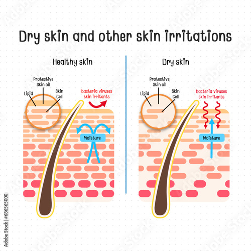 Dry skin and other skin irritations photo