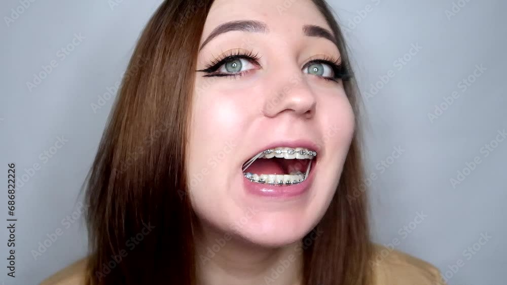 Young lady in braces opens mouth wide, shows tension of corrective orthodontic elastics. Close-up: blogger in braces share with us orthodontic treatment process with elastics. Braces treatment concept Young lady in braces opens mouth wide, shows tension of corrective orthodontic elastics. Close-up: blogger in braces share with us orthodontic treatment process with elastics. Braces treatment concept