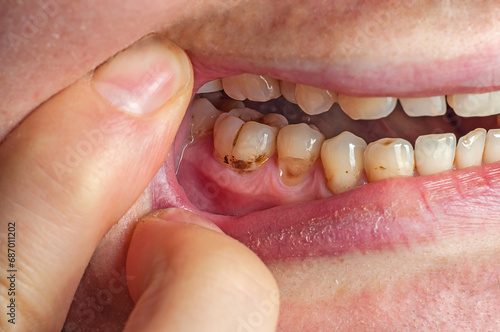 Fotografie Teeth with plaque close-up. The filling fell off the tooth