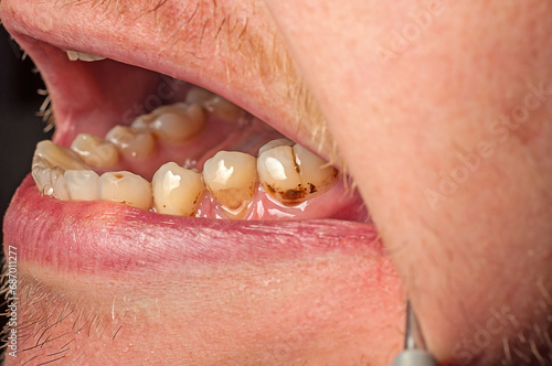 Close-up of brown teeth with plaque and caries. The filling fell off the tooth photo