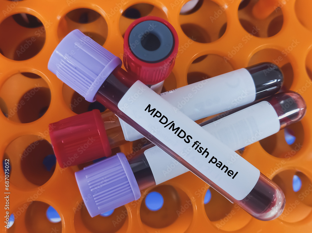 Sample Mds Blood sample for Myelodysplastic syndrome test. To diagnose MDS – a ...