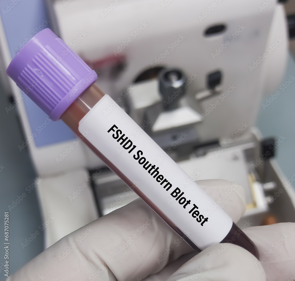 Blood sample for FSHD1 Southern Blot Test, deletions on chromosome 4q35 in patients with facioscapulohumeral dystrophy (FSHD).