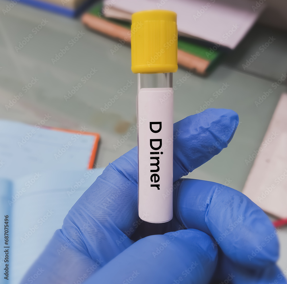 DDimer test. Corona patient monitoring test in ICU. Doctor or