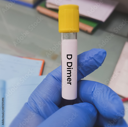 D-Dimer test. Corona patient monitoring test in ICU. Doctor or scientist hold a blood sample for test. close view.deep venous thrombosis. disseminated intra vascular coagulation. aortic dissection. photo