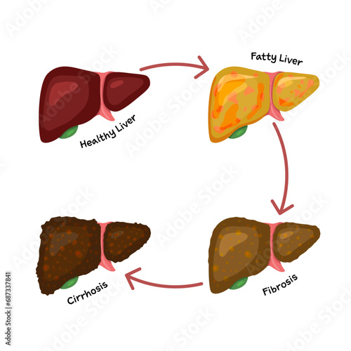 stage of liver damage fatty liver fibrosis cirrhosis medical healthcare disease health hospital photo