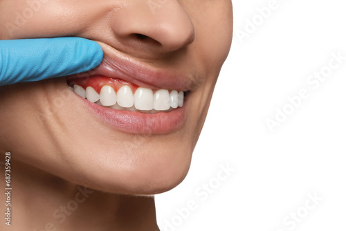 Εκτύπωση καμβά Doctor examining woman's inflamed gum on white background, closeup