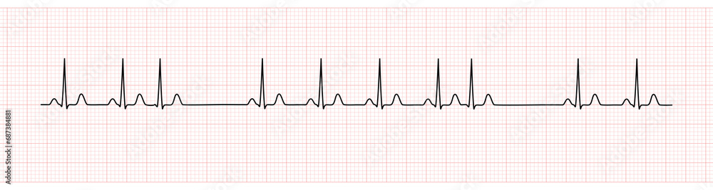 EKG Monitor Showing  Sinus Rhythm with PAC