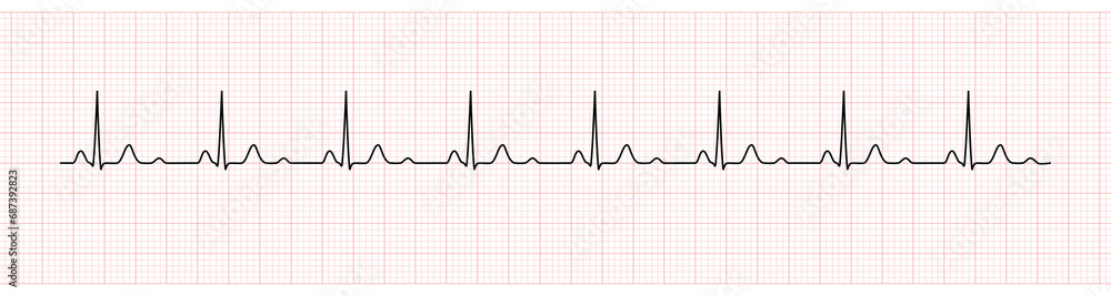 EKG Monitor Showing  Sinus Rhythm with U wave represented Hypokalemia
