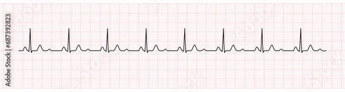 EKG Monitor Showing  Sinus Rhythm with U wave represented Hypokalemia