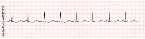 EKG Monitor Showing  Sinus Rhythm with U wave represented Hypokalemia