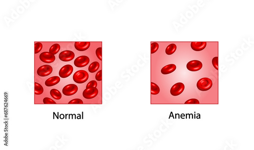 Iron deficiency anemia. The difference of Anemia amount of red blood cell and normal. Blood droplet. Blood donation. Realistic vector 3d picture. Vector illustration isolated on white background.