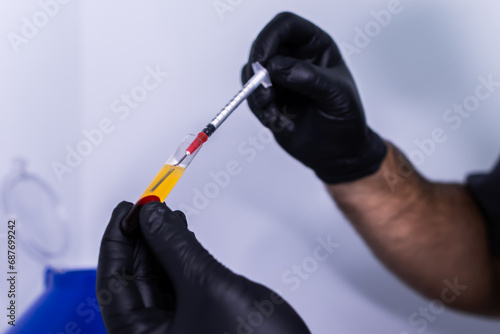 Close-up photo of a doctor's hands extracting platelet-rich plasma from a tube of blood after centrifugation. PRP therapy