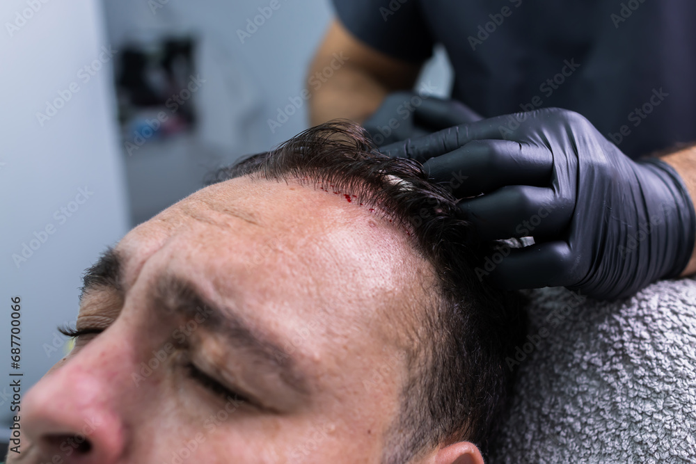 Fototapeta premium Close-up photo of a patient's scalp with blood dots after a PRP treatment for hair loss.