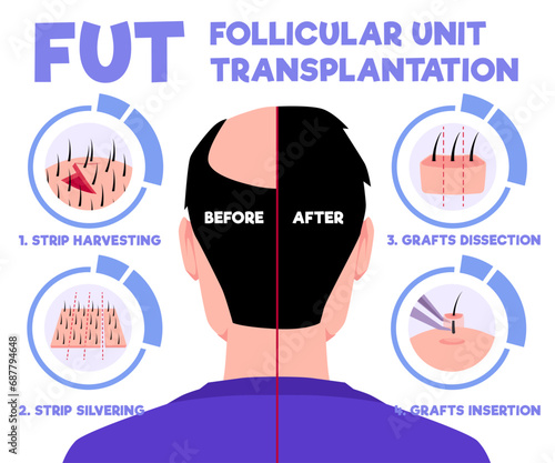 FUT hair transplantation alopecia treatment in 4 steps of follicular unit transplantation restoration surgery vector info