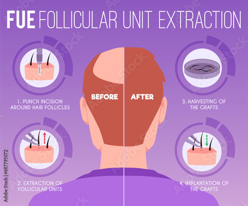 Hair transplantation, medical infographic with man, vector illustration photo