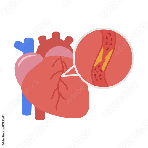 Coronary Heart Artery Vector Illustration