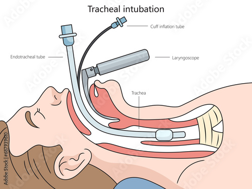 Tracheal intubation structure diagram hand drawn schematic raster illustration. Medical science educational illustration photo