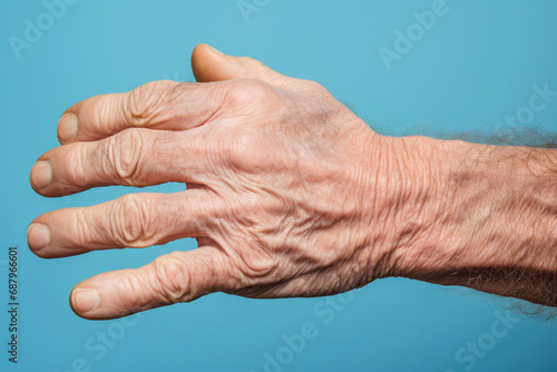 The rough and swollen hand of a senior male, depicting the challenges of geriatric health and the concept of elderly care.
