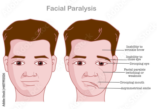 Facial paralysis. Bell palsy. Drooping eyes. twitching weakness causes. asymmetric face, smile. Medical illustration vector