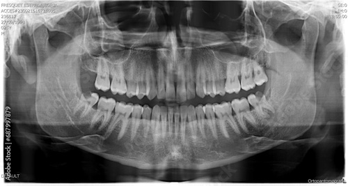 HUMAN PATHOLOGICAL AND ANATOMICAL RADIOGRAPHY (Cavities)