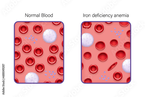 Comparison between normal blood and iron deficiency anemia vector. Blood smear. Medical education. 