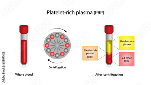 Platelet-rich plasma (prp). Autologous conditioned plasma, is a concentrate of platelet-rich plasma extracted from whole blood. After centrifugation, Extract PRP and Inject. Vector Illustration