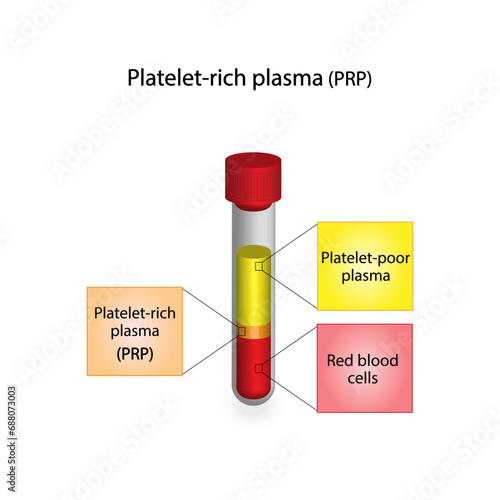 Platelet-rich plasma (prp). Autologous conditioned plasma, is a concentrate of platelet-rich plasma extracted from whole blood. After centrifugation, Extract PRP and Inject. Vector Illustration