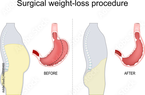 Stomach reduction. Vertical sleeve gastrectomy