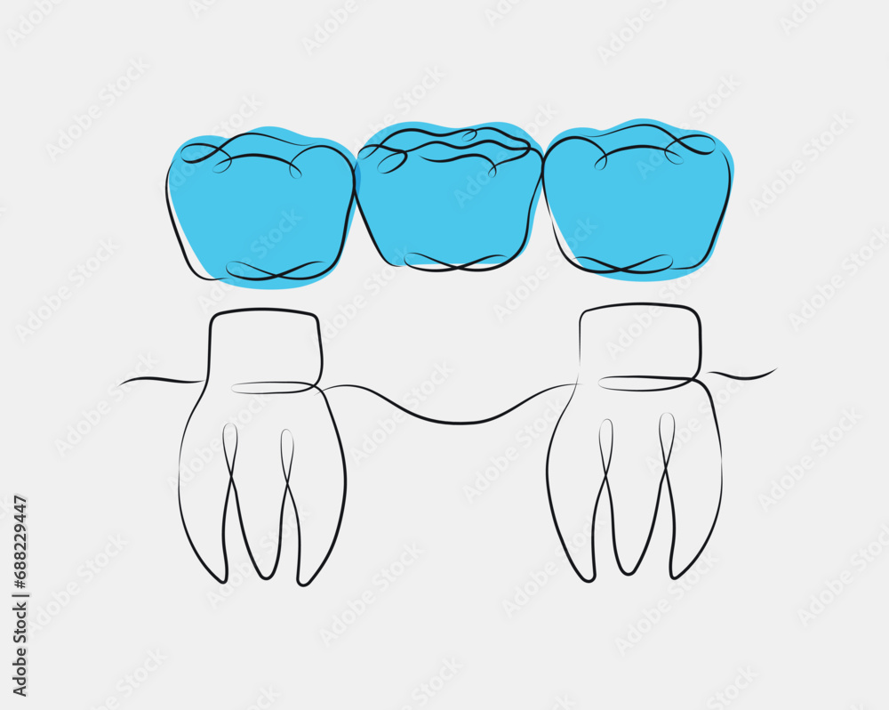 Teeth with crown bridge illustration drawing in linear style on white and blue background