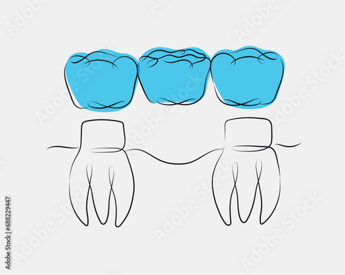 Obraz na płótnie Teeth with crown bridge illustration drawing in linear style on white and blue background w salonie