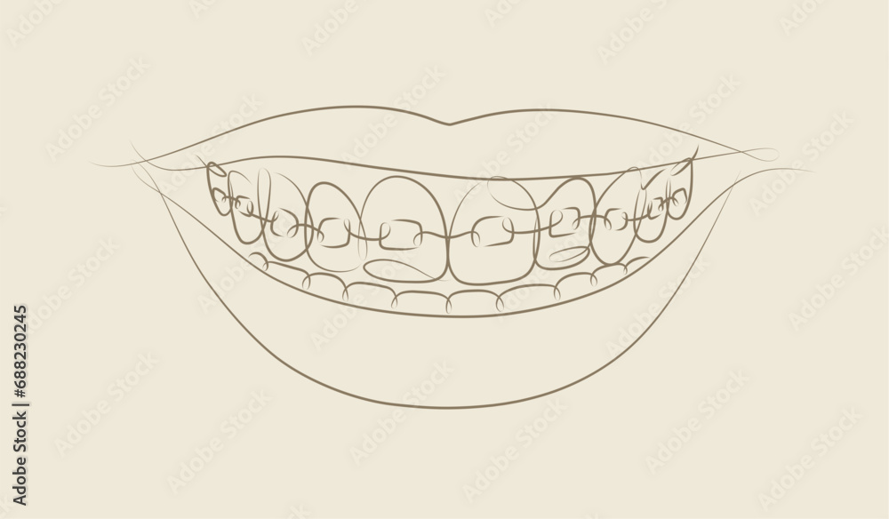 Smile with teeth braces in linear style drawing on beige background