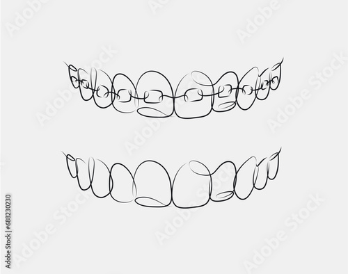 Jaws with and without braces installed drawing in linear style on white background