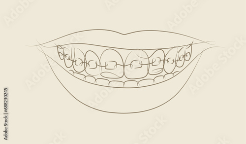 Obraz na płótnie Smile with teeth braces in linear style drawing on beige background w salonie