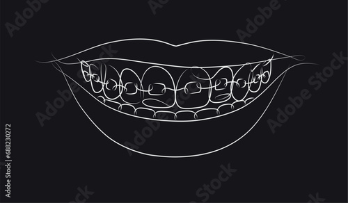 Obraz na płótnie Smile with teeth braces in linear style drawing on black background w salonie