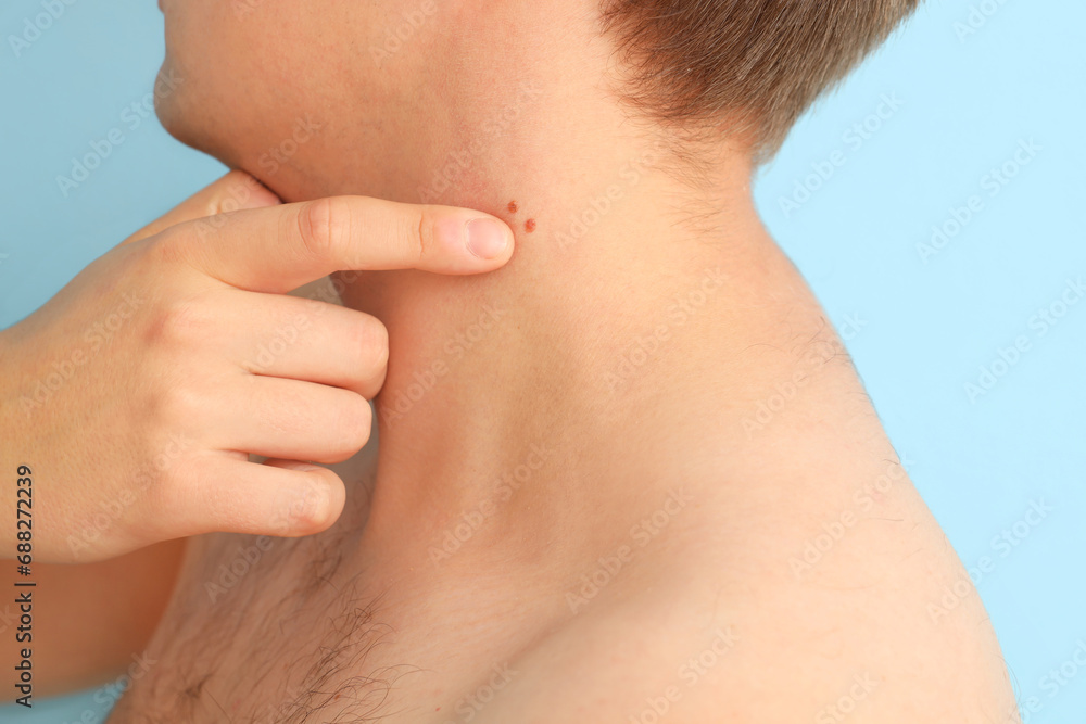 Young man pointing at moles on his neck against blue background, closeup Young man pointing at moles on his neck against blue background, closeup