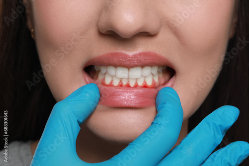 Doctor examining woman's inflamed gum, closeup. Oral cavity health