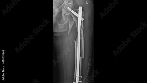 femur Fracture with Intramedullary Nail photo