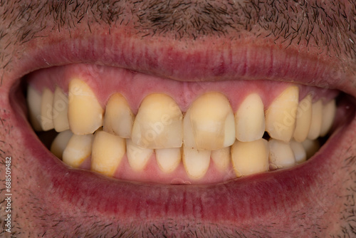 emax crowns and veneers photo