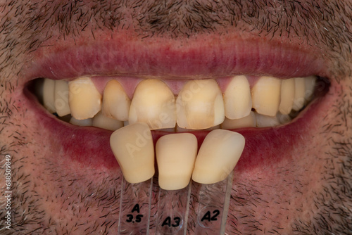 emax crowns and veneers photo