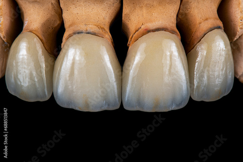 emax crowns and veneers