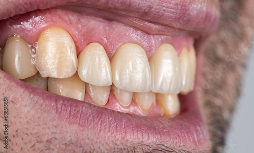 emax crowns and veneers