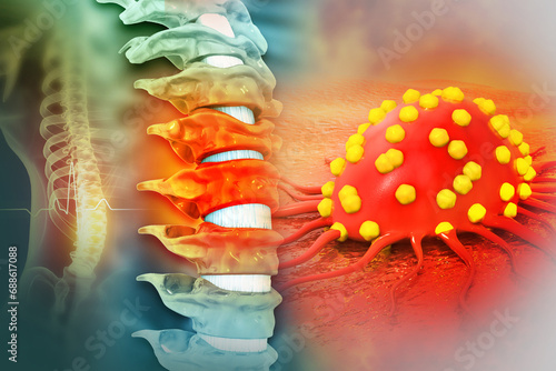 Spine cancer or spinal tumor disease. 3d illustration photo