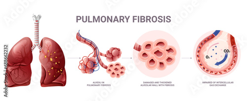 Pulmonary fibrosis infographic. Vector illustration isolated on white background