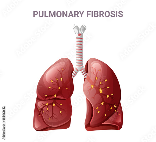 Pulmonary fibrosis and normal lung. Vector illustration isolated on white background