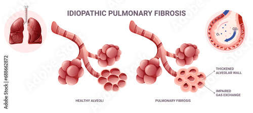 Idiopathic pulmonary fibrosis infographic. Vector illustration isolated on white background photo